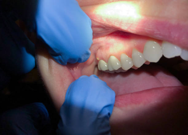 Best Knocked-Out Tooth Emergency  in Gates Mills, OH